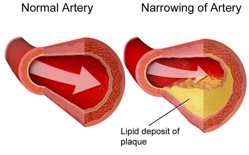 Cholesterol and Our Health
